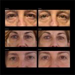 OVER SIZE EYE & CHEEK PATCHES