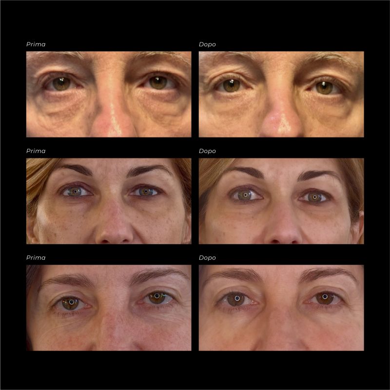 OVER SIZE EYE & CHEEK PATCHES